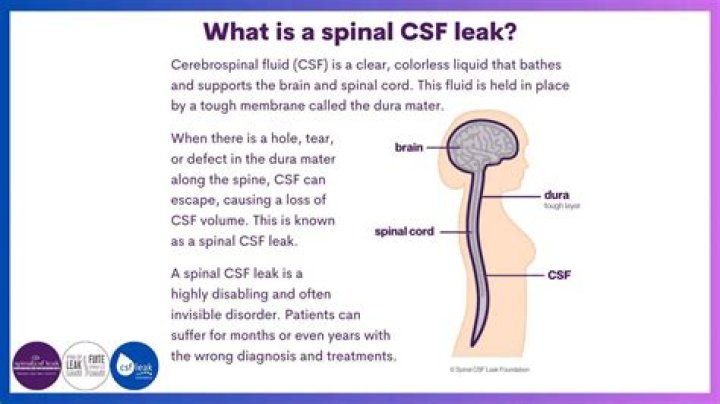 Can sinusitis cause CSF leak?
