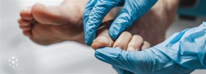 Does lupus affect the toes?