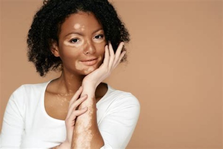 How can I fix discolored skin naturally?